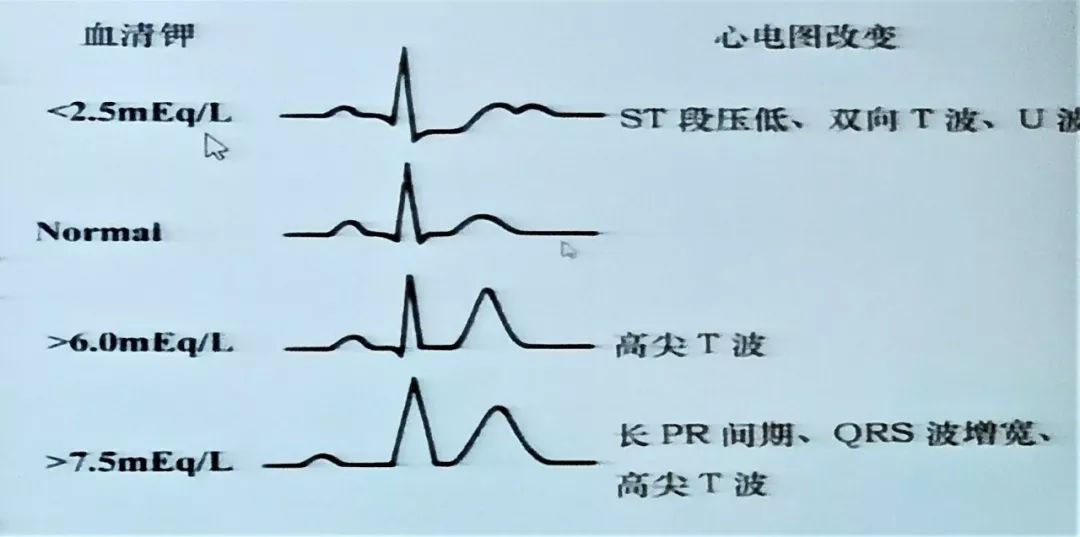 儿童心电图——你真的会读了吗？
