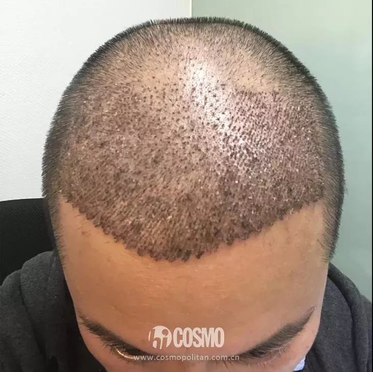 OMG | 植发后第四个月，本CO男友拿起了王鸥同款生发液
