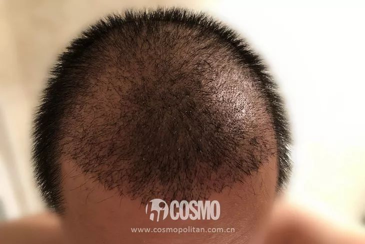OMG | 植发后第四个月，本CO男友拿起了王鸥同款生发液