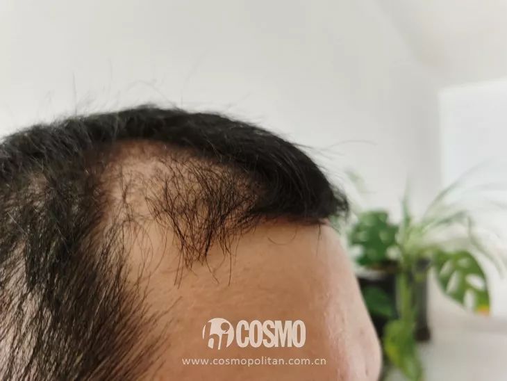 OMG | 植发后第四个月，本CO男友拿起了王鸥同款生发液