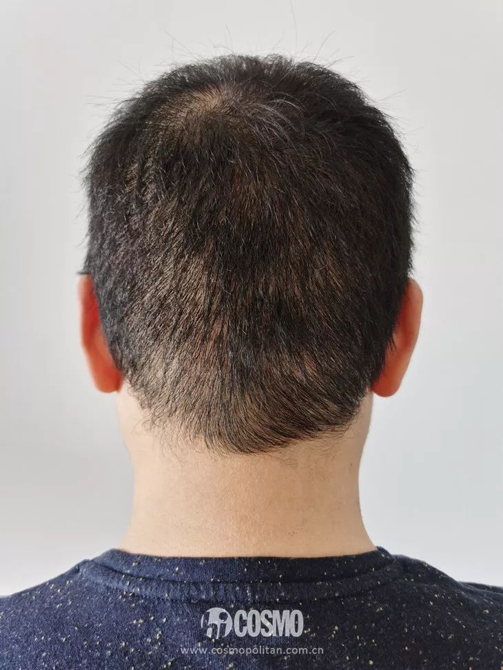 OMG | 植发后第四个月，本CO男友拿起了王鸥同款生发液