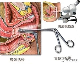 什么是宫颈活检