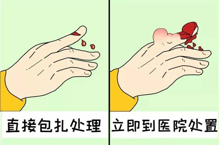 指甲掉了怎么处理伤口(不小心伤到手) - seo葵花宝典
