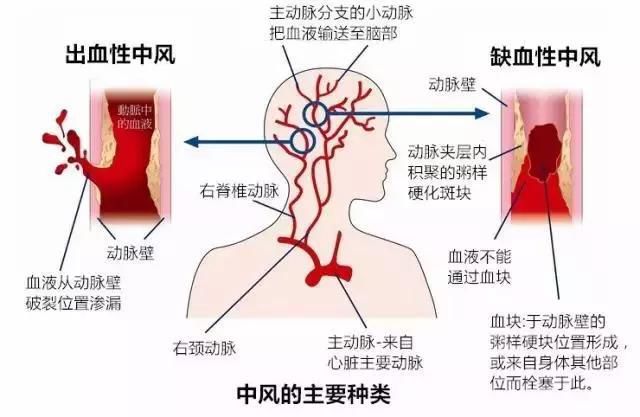 中国人的“头号杀手”不是癌症，是它