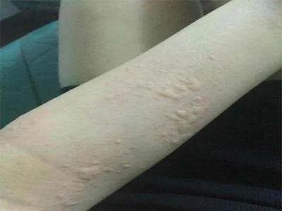 痒到想死！孩子得了荨麻疹，怎么办？
