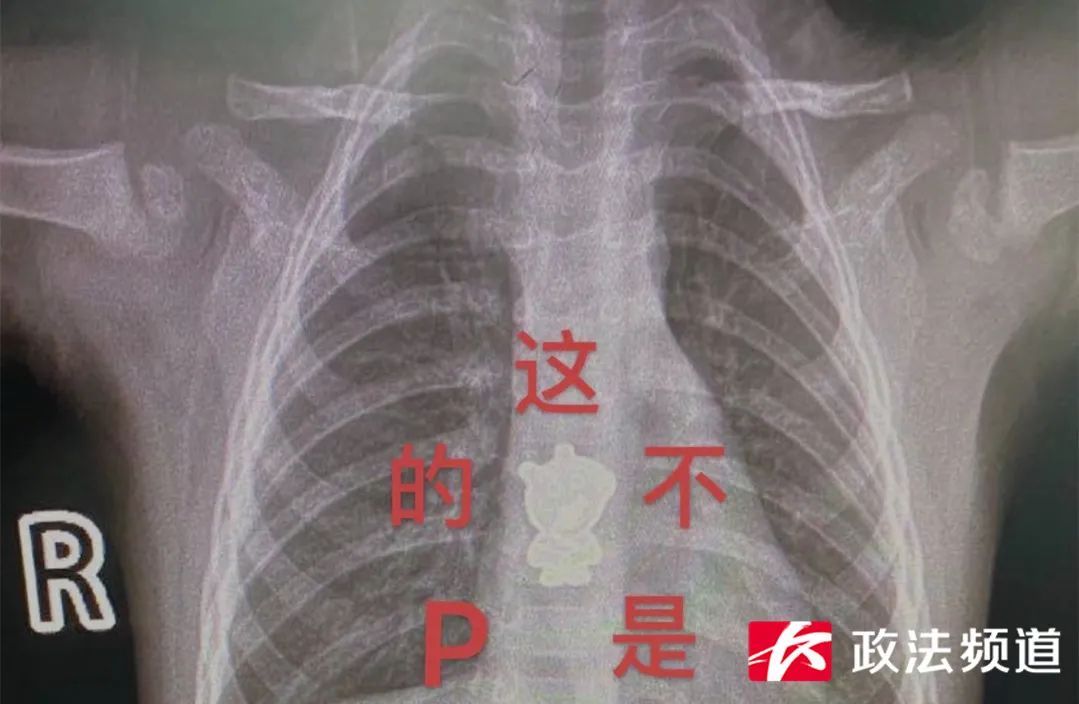 真不是P的！女童CT片里惊现小猪佩奇？真相可怕