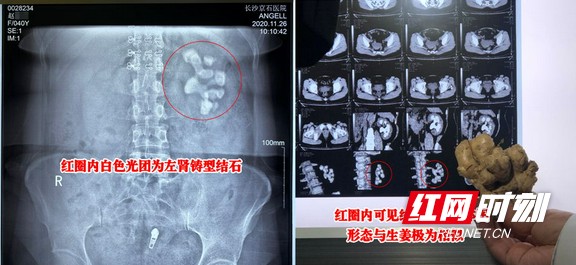 女子孕期突然尿血 查出左肾长9厘米“老生姜”肾脏近乎“石化”