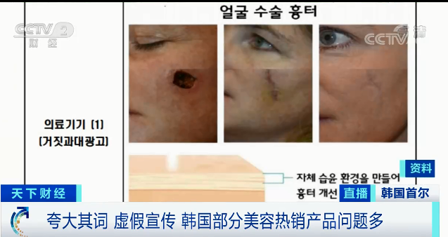 曝光！这些网红韩国爆款减肥霜、疤痕贴，涉嫌虚假宣传！国内电商在售