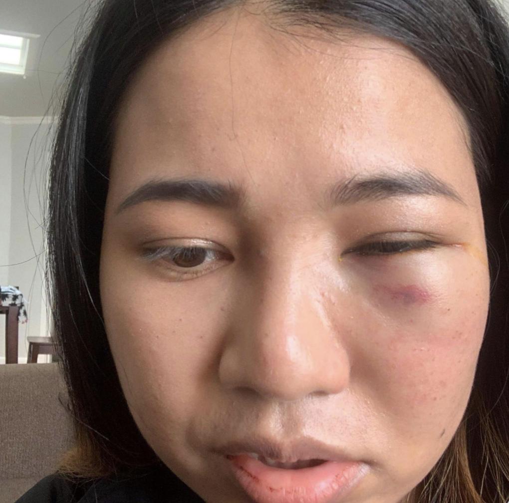 脸被打肿了怎么办才能消肿，脸被打肿一般几天恢复