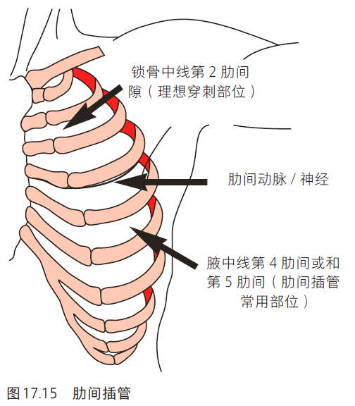 第二肋间定位图片图片