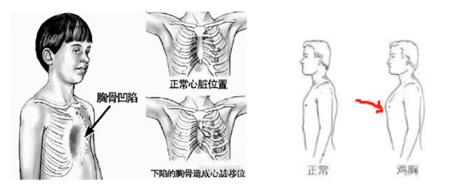 宝宝胸前有个坑，咋回事？——鸡胸姊妹篇