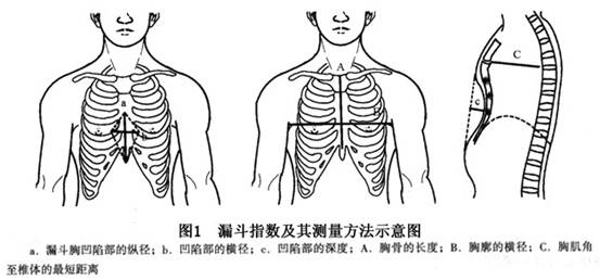 宝宝胸前有个坑，咋回事？——鸡胸姊妹篇