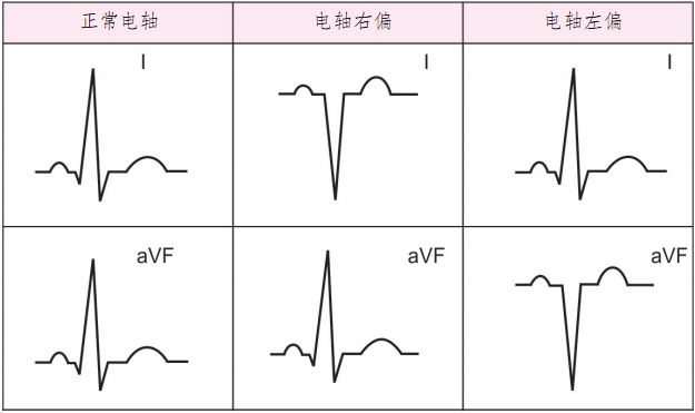 心电图怎么看正常不正常，简简单单看懂心电图各项参数