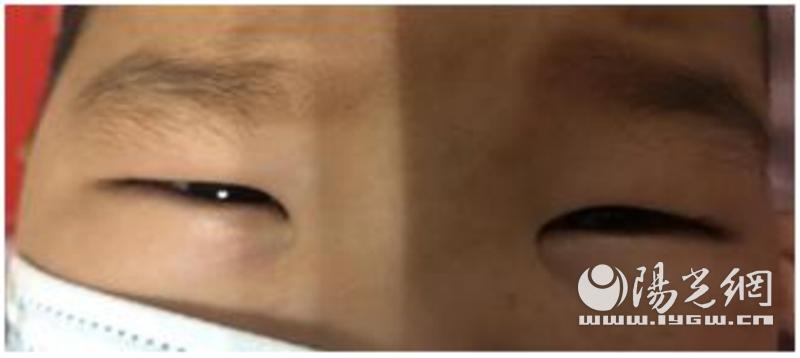 儿童双眼浮肿、小便量少莫大意，警惕“肾病综合征”