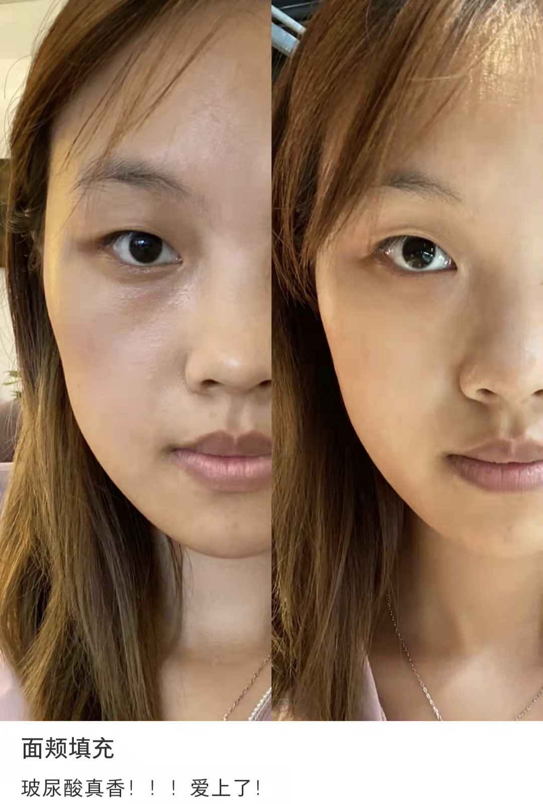 医美暴利？那整形医院的钱都被谁赚走了？