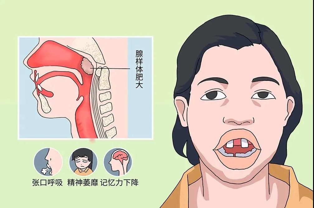 小儿腺样体肥大危害大，中医治疗有优势