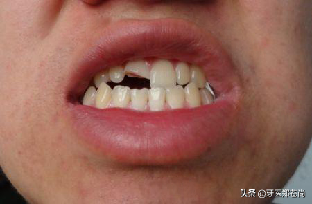 牙齿几年前掉了一块，现在还能补吗？