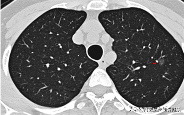 如何让你的肺结节变小甚至消失？