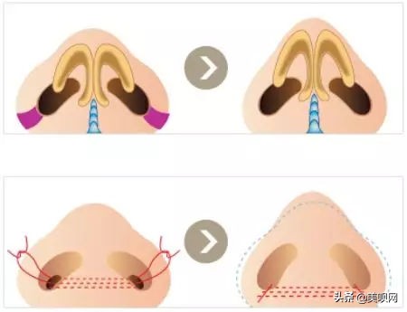 鼻翼缩小有什么神力，小樱花、金南珠等一众明星都在做？