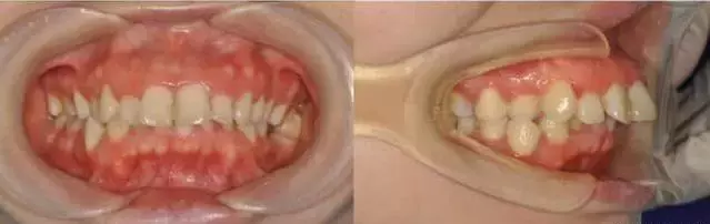 龅牙嘴突+露龈笑：牙齿矫正告诉你这些都还有救