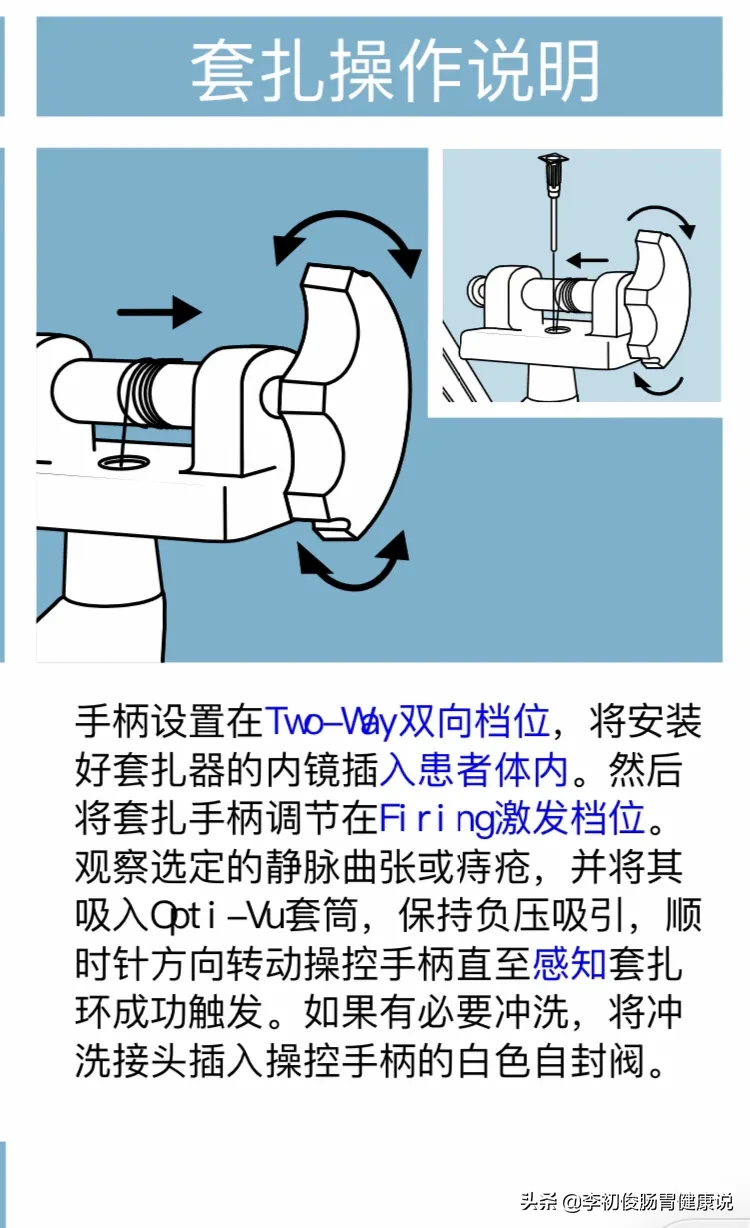 一次肠镜操作,一举三得同时完成肠道检查、套扎止血、消除内痔!