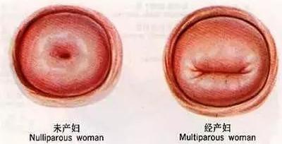 从怀孕到分娩,女性的阴道扩张到数百倍,尤其是自然分娩造成的阴道损伤