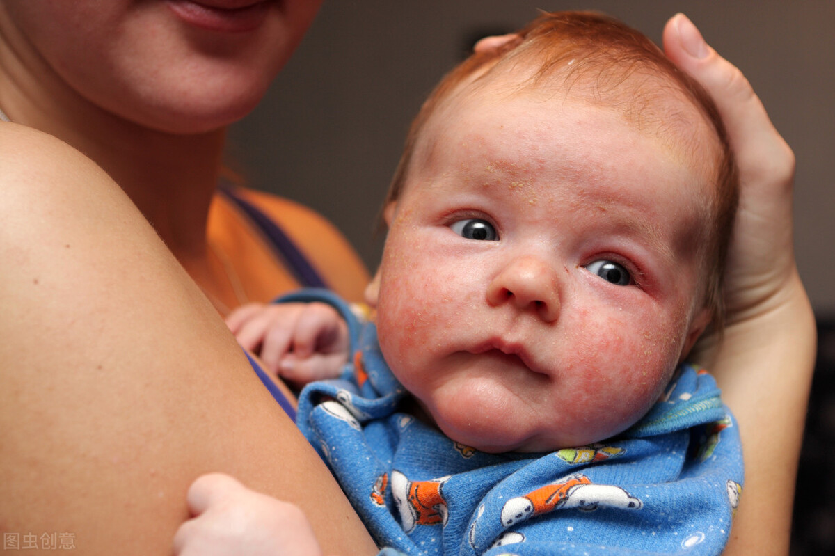 奶疹和湿疹的区别图片及护理（新生儿过敏引起的奶疹如何处理？） | 说明书网