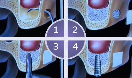 为什么有些人做种植牙，得先植骨？植入的到底是什么？
