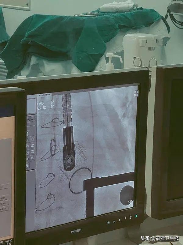 福建省立医院心外科黄烽主任：术式无高下，适合个人的，才是最好的