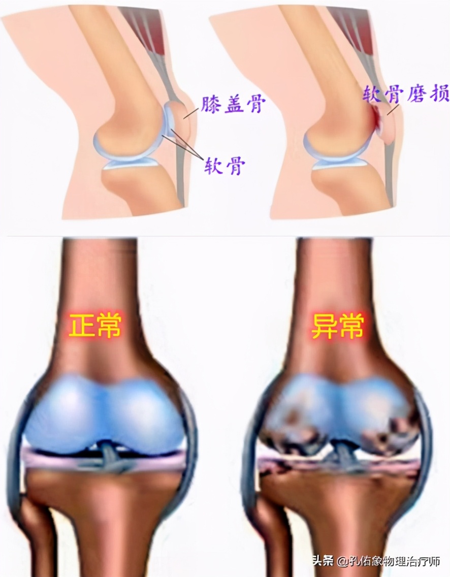 膝关节在下蹲、上下楼梯疼，还会响，为何？盘点6个原因，请收藏