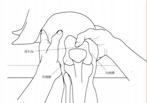 髌骨脱位能不能保守治疗？医生：这种类型才可以，4点要注意