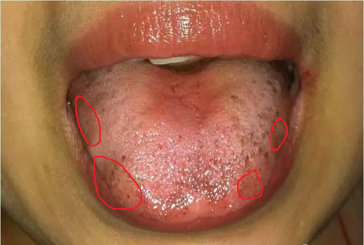 血瘀生百病,一张图辨别自己是不是血瘀体质