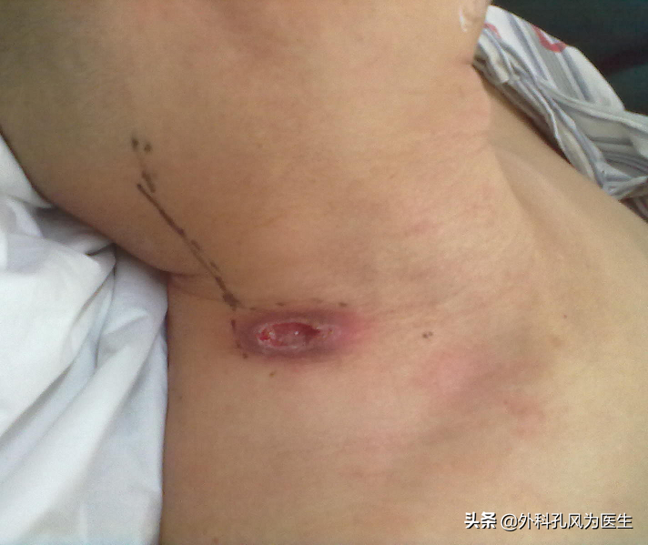 爱美女性朋友应注意:脖子上长"疙瘩",警惕"老鼠疮"