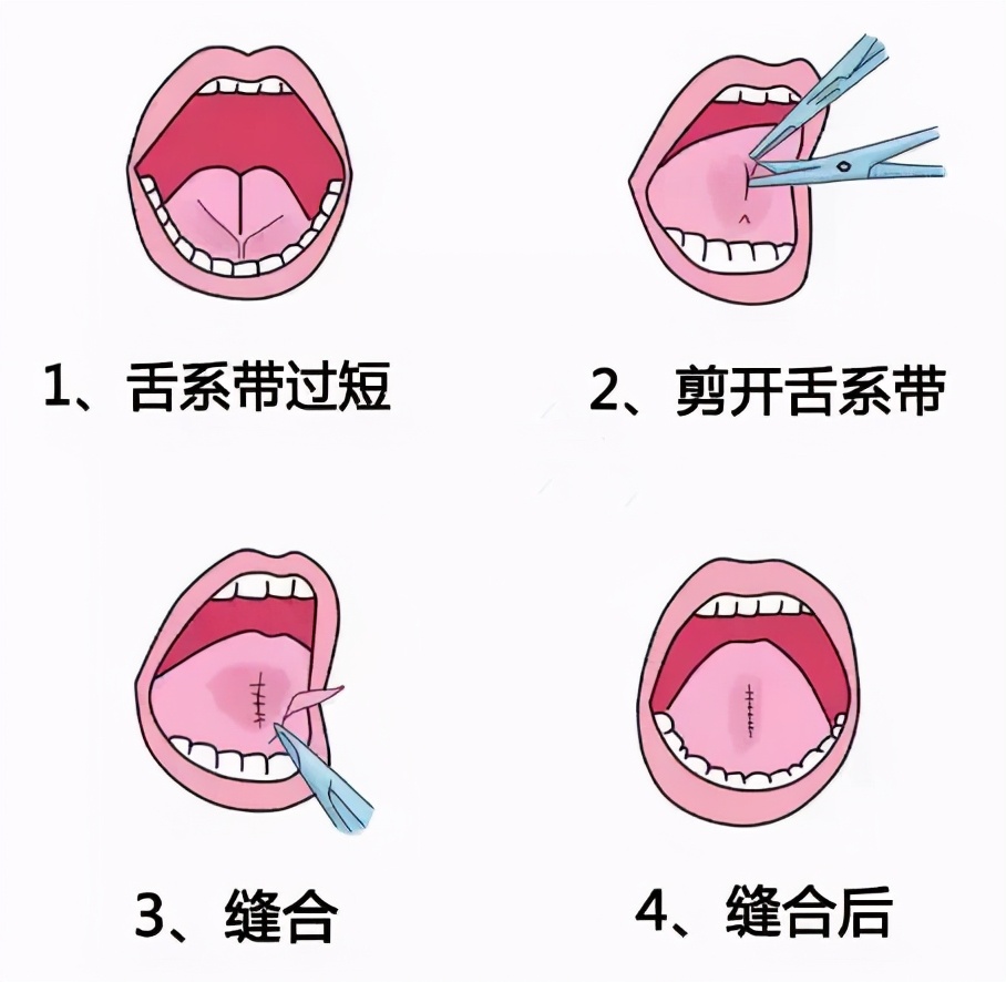 滥用的“剪舌系带”，舌系带到底该不该剪？这一刀孩子挨得很无辜