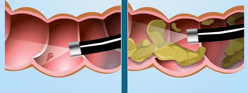 疫情当下医生不建议来医院查肠镜，担心息肉会长出来，该怎么办？