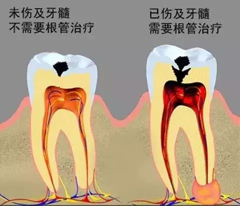 补牙要趁早!小龋坏久拖不治,最后花费上万,冤不冤?