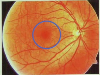 警惕眼底病變之年齡相關性黃斑變性