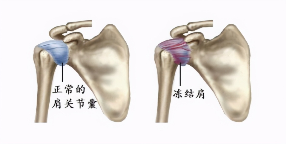 骨科医生：肩周炎可以自愈，但要经过这 4 个阶段