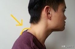 脖子后面凸一包是“富贵包”吗？如何消除？这个方法简单又有效