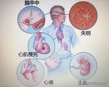 三高（高血压、高血脂、高血糖），哪一个对人的威胁和危害最大
