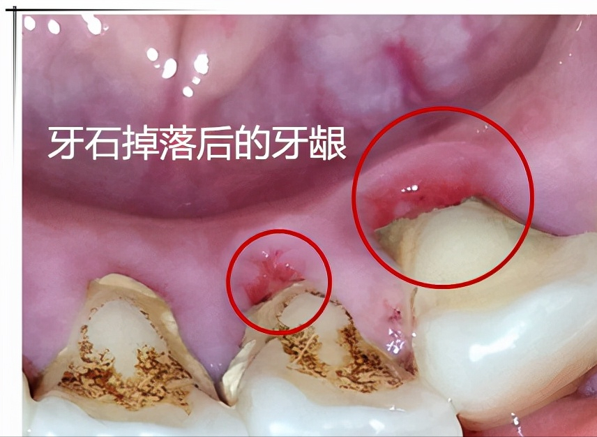 洗牙一次大概多少钱，清洗一次多长时间？