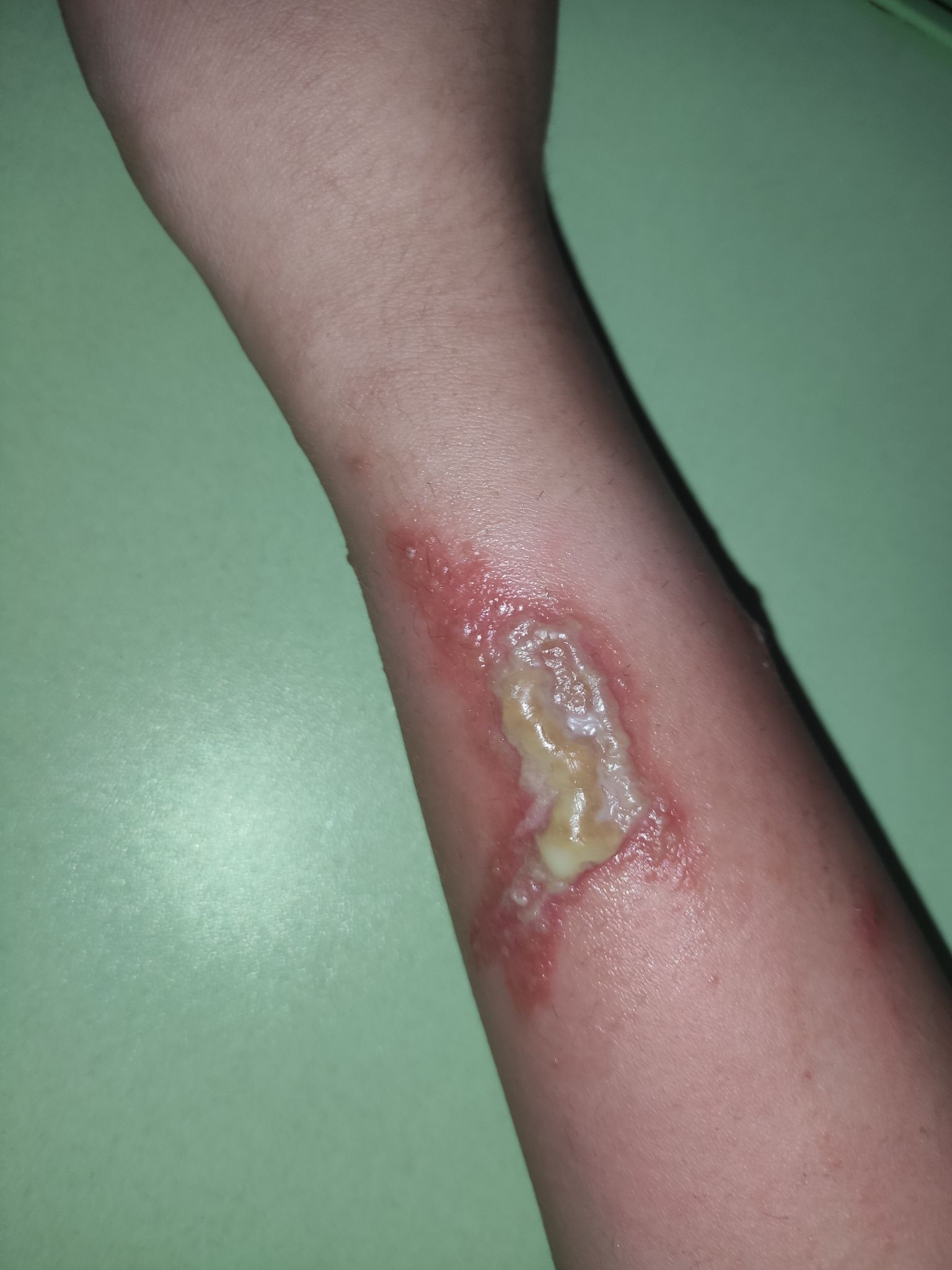 拍一下就会皮肤溃烂的虫子—隐翅虫