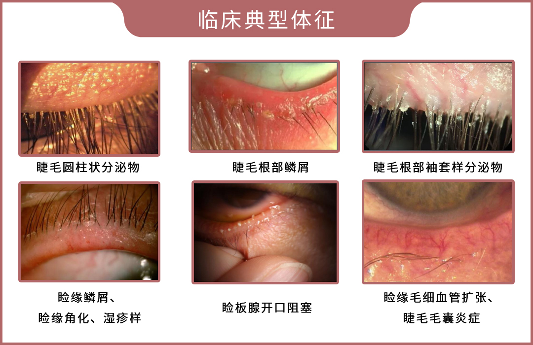 近视眼和老花眼可以抵消？网上配镜靠谱吗？一文全知道