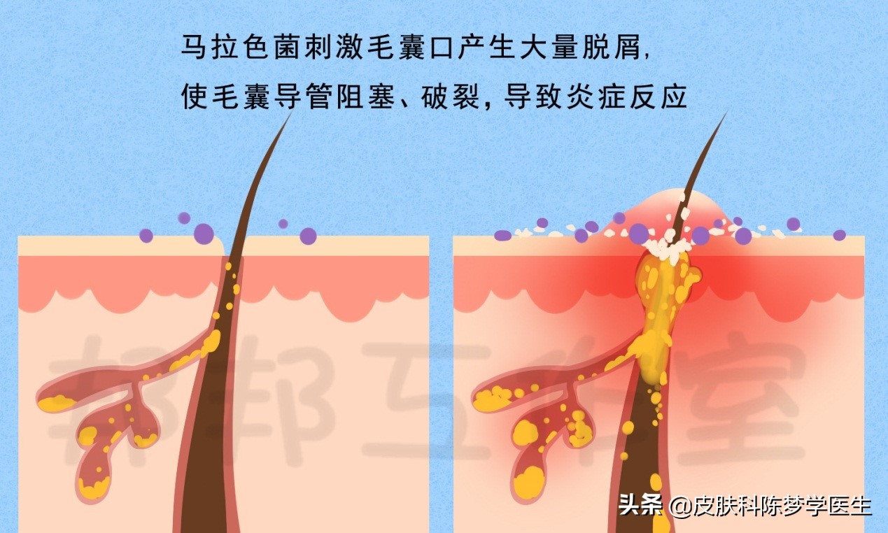 痘痘始终不好，小心是马拉色菌惹的祸