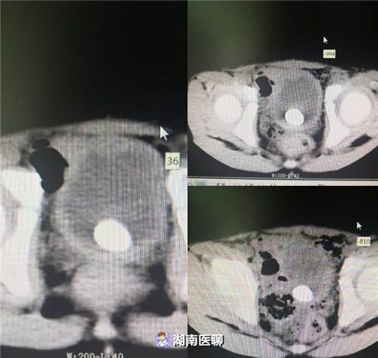 男童膀胱结石反复尿频尿痛血尿如何快速排出