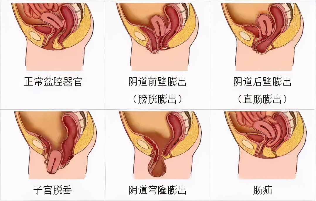 阴部前壁膨出症状图片