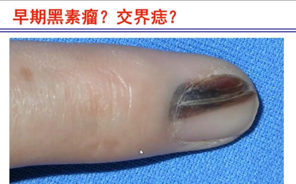指甲上有条黑线是什么病？甲黑色素瘤or甲母痣？良性还是恶性？