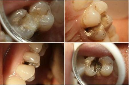 牙齿发黑发黄是怎么回事？不痛不痒需要看医生吗？其实问题很大