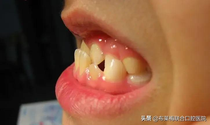 牙齿矫正,你所关心的那些问题