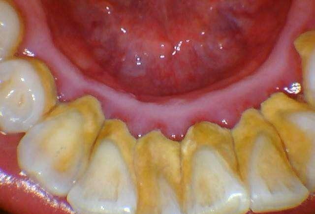 牙菌斑图片(") - 赤虎壹号